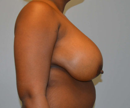 Breast Reduction Before & After Patient #4014