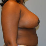 Breast Reduction Before & After Patient #4014