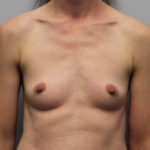 Breast Augmentation Before & After Patient #4027