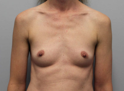 Breast Augmentation Before & After Patient #4027