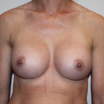 Breast Augmentation Before & After Patient #4027