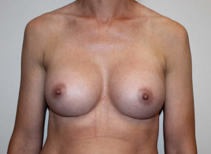 Breast Augmentation Before & After Patient #4027