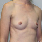 Breast Augmentation Before & After Patient #4027