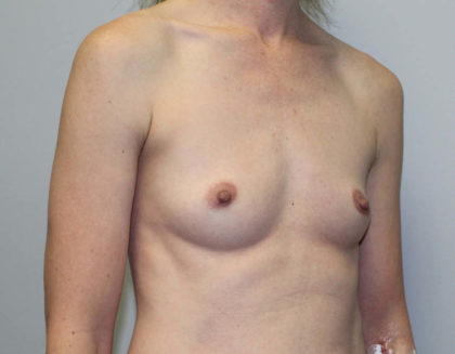 Breast Augmentation Before & After Patient #4027