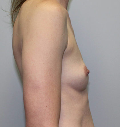 Breast Augmentation Before & After Patient #4027