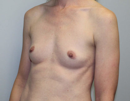 Breast Augmentation Before & After Patient #4027
