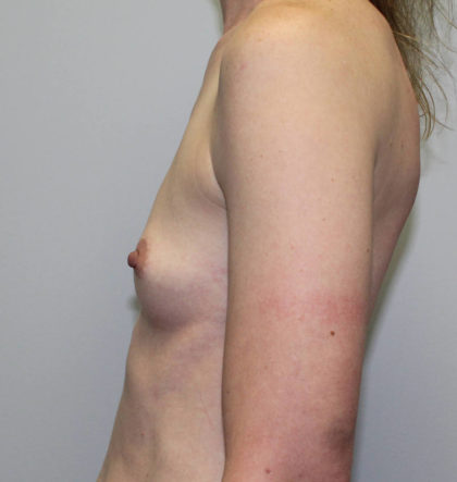 Breast Augmentation Before & After Patient #4027