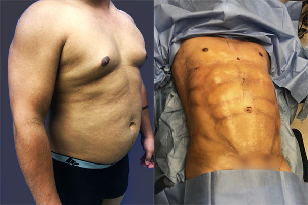 Vaser High Definition Liposuction Before & After Photos