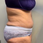 Tummy Tuck Before & After Patient #4058