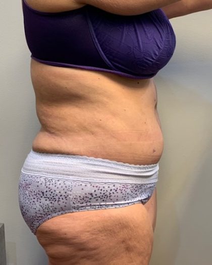 Tummy Tuck Before & After Patient #4058