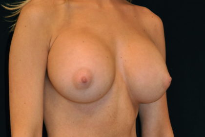 Breast Augmentation Before & After Patient #4117