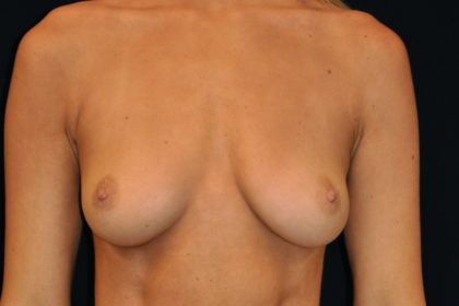 Breast Augmentation Before & After Patient #4117