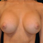 Breast Augmentation Before & After Patient #4117