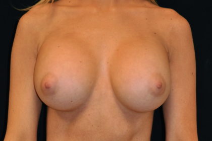 Breast Augmentation Before & After Patient #4117