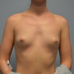 Breast Augmentation Before & After Patient #4139