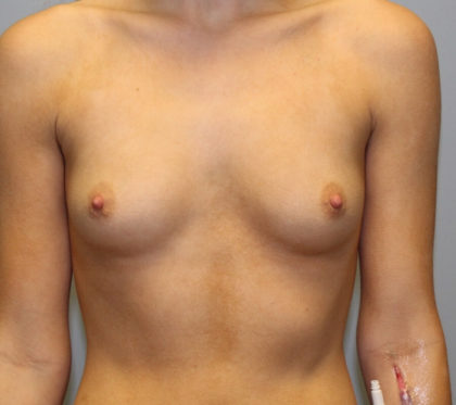 Breast Augmentation Before & After Patient #4151