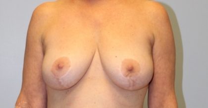 Breast Lift Before & After Patient #4112