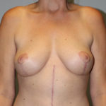 Breast Lift Before & After Patient #4144