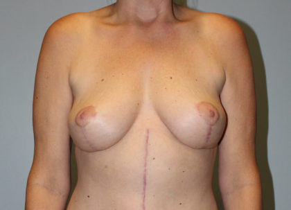 Breast Lift Before & After Patient #4144