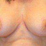 Breast Lift Before & After Patient #4200