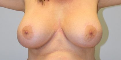 Breast Lift Before & After Patient #4200