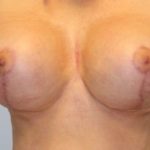 Breast Lift Before & After Patient #4200