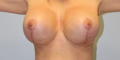 Breast Lift Before & After Patient #4200