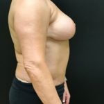 Breast Reduction Before & After Patient #4278