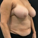 Breast Reduction Before & After Patient #4278