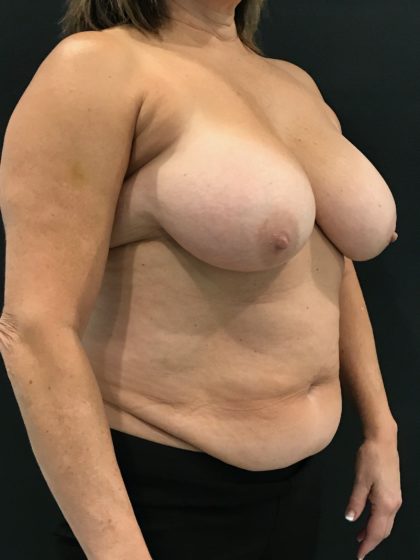 Breast Reduction Before & After Patient #4278