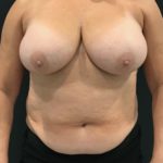 Breast Reduction Before & After Patient #4278