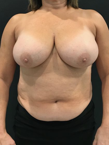 Breast Reduction Before & After Patient #4278