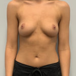 Breast Augmentation Before & After Patient #4251