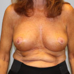 Breast Lift Before & After Patient #4299