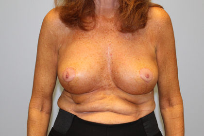 Breast Lift Before & After Patient #4299