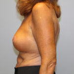 Breast Lift Before & After Patient #4299