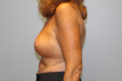 Breast Lift Before & After Patient #4299