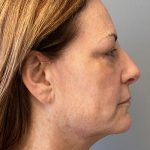 Facial Rejuvenation Before & After Patient #4627