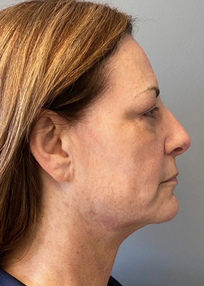 Facial Rejuvenation Before & After Patient #4627