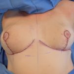 Breast Reduction Before & After Patient #4655