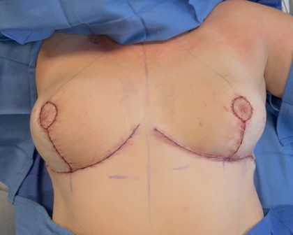 Breast Reduction Before & After Patient #4655