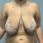 Breast Reduction Before & After Patient #4655