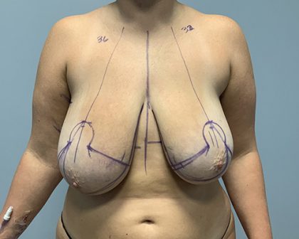 Breast Reduction Before & After Patient #4655