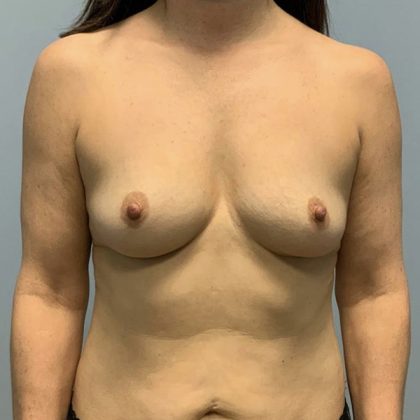 Breast Augmentation Before & After Patient #4648