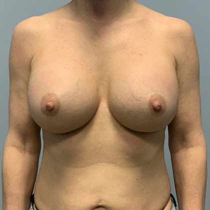 Breast Augmentation Before & After Patient #4648