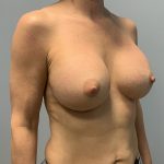 Breast Augmentation Before & After Patient #4648