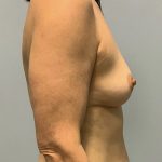 Breast Augmentation Before & After Patient #4648