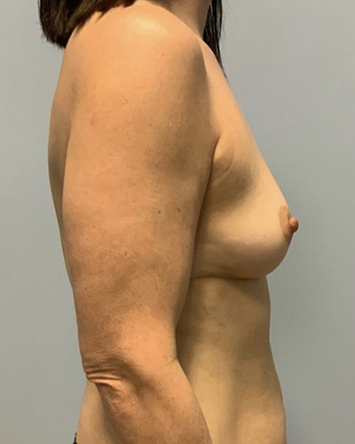 Breast Augmentation Before & After Patient #4648