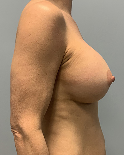 Breast Augmentation Before & After Patient #4648