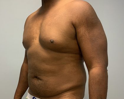 Hi Def Liposuction Before & After Patient #4634